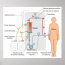 Pesquisar por diagrama médico pôsteres Hemodiálise