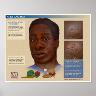 Acne melálica e Poster médica de dieta