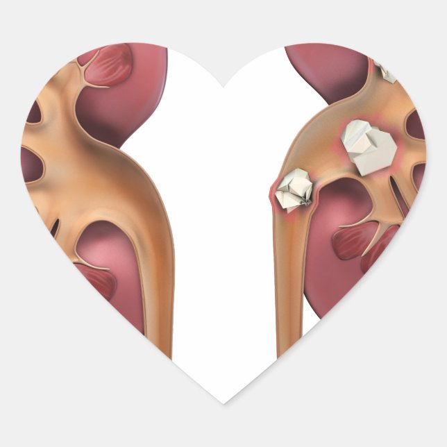 Adesivo Coração rins (Frente)