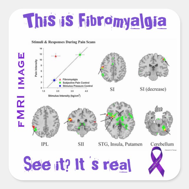 Adesivo Quadrado A fibromialgia é real. Você pode vê-lo em uma fMRI (Frente)