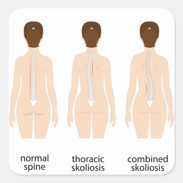 Adesivo Quadrado Deformação espinal (Frente)
