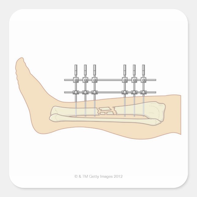 Adesivo Quadrado Fixador externo (Frente)