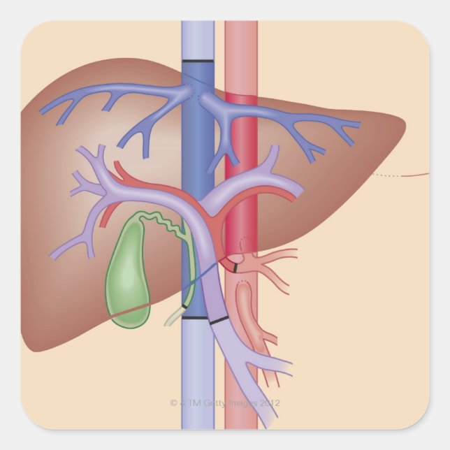 Adesivo Quadrado Procedimento de transplante hepático (Frente)