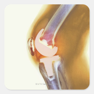 Adesivo Quadrado Substituição do joelho. Raio X colorido de um