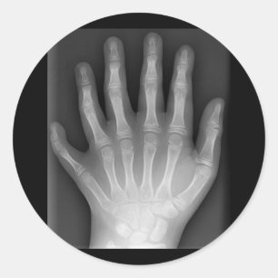 Adesivo Redondo Polydactyly, seis mãos apontado, raio X, raridade