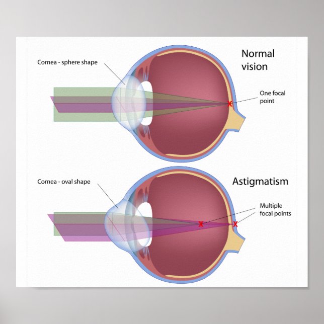 Astigmatismo, Poster de defeito ocular comum (Frente)