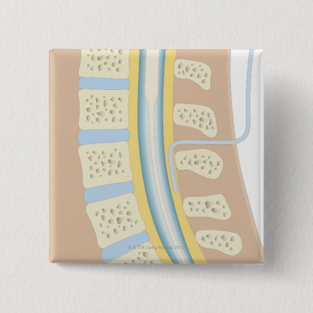 Bóton Quadrado 5.08cm Anestesia Epidural (Frente)