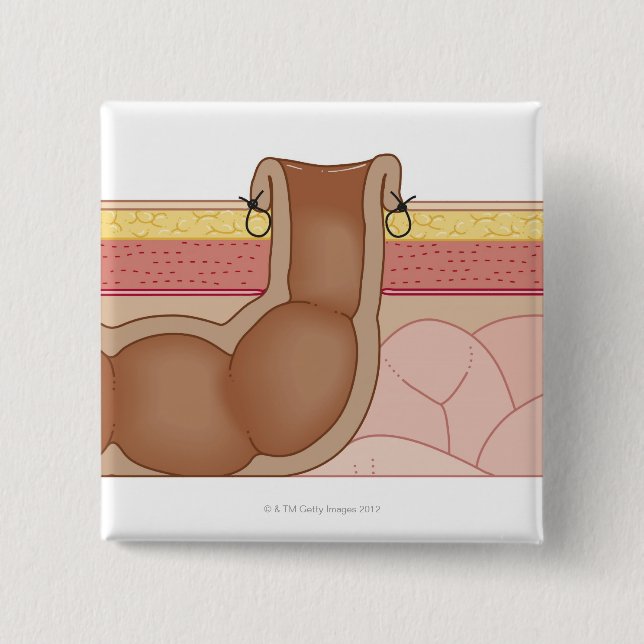 Bóton Quadrado 5.08cm Colostomia Permanente (Frente)
