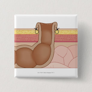 Bóton Quadrado 5.08cm Colostomia permanente