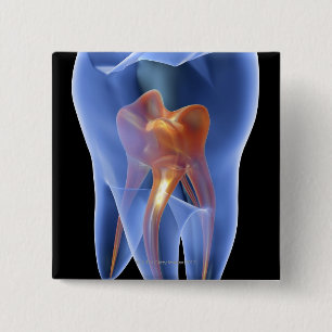 Bóton Quadrado 5.08cm Dente, secção transversal transparente de um mol