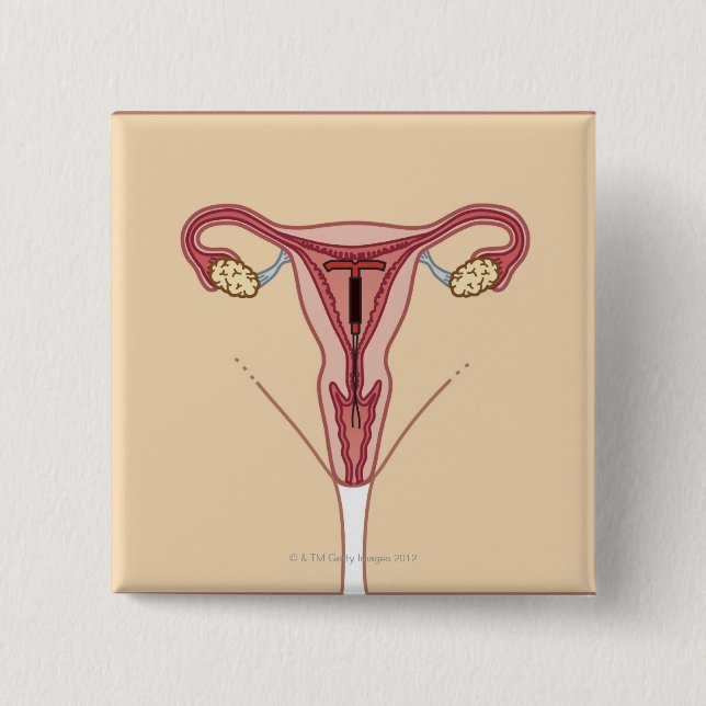 Bóton Quadrado 5.08cm Dispositivo Intrauterino (Frente)