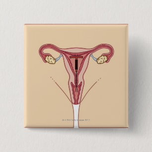 Bóton Quadrado 5.08cm Dispositivo Intrauterino