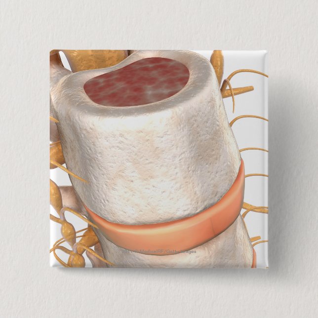 Bóton Quadrado 5.08cm Feche acima de um disco invertebral na espinha (Frente)