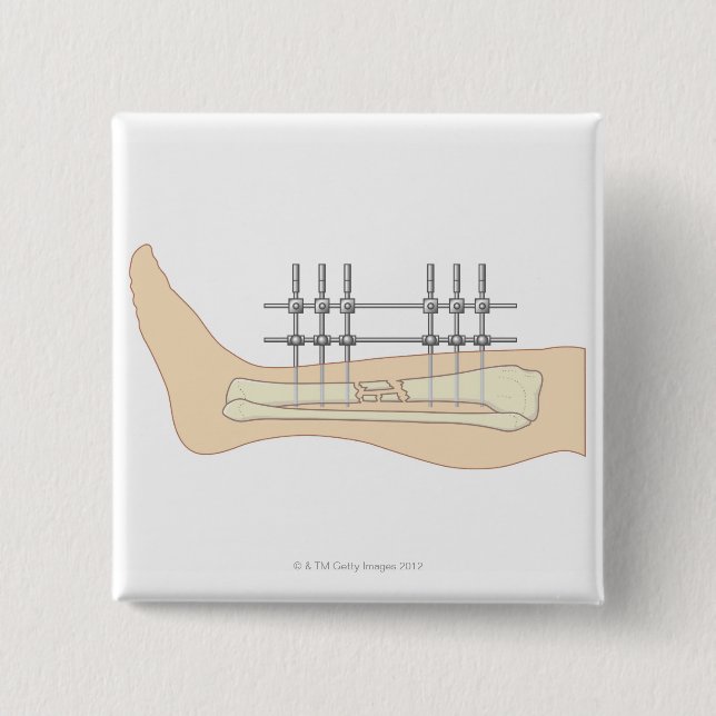 Bóton Quadrado 5.08cm Fixador externo (Frente)