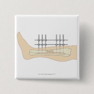 Bóton Quadrado 5.08cm Fixator externo