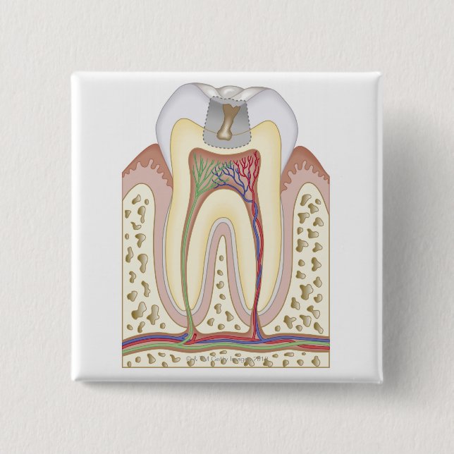 Bóton Quadrado 5.08cm Ilustração do Decaimento dos Dentes (Frente)