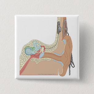 Bóton Quadrado 5.08cm Implantes Cocleares