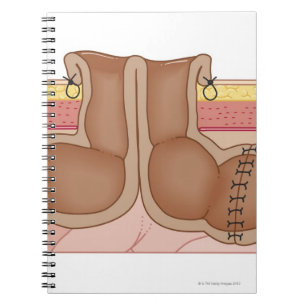 Caderno Espiral Colostomia provisória