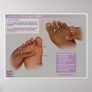 Calluses, cornos e verrugas Poster