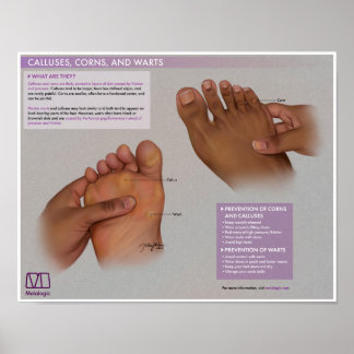 Calluses, cornos e verrugas Poster