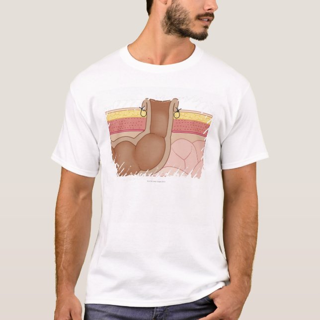 Camiseta Colostomia permanente (Frente)