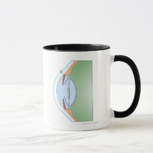 Caneca Cirurgia da catarata
