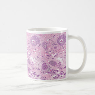 Caneca De Café Células cancerosas do Caneca-Peito do café