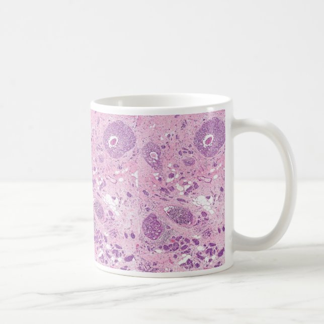 Caneca De Café Células cancerosas do Caneca-Peito do café (Direita)