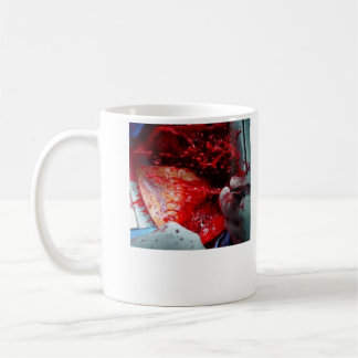 Caneca De Café Dissecção aórtica de ascensão