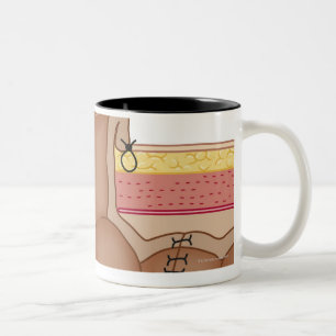 Caneca De Café Em Dois Tons Colostomia provisória