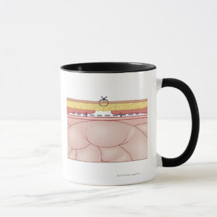 Caneca Ilustração de uma hérnia