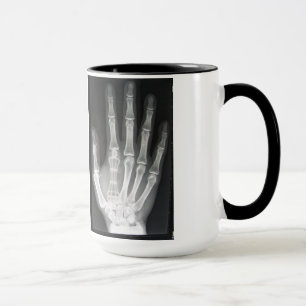 Caneca Rainha no raio X da mão