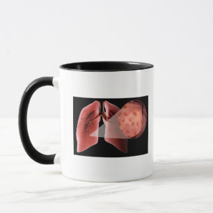 Caneca Via aérea de Inflammed durante um ataque de asma