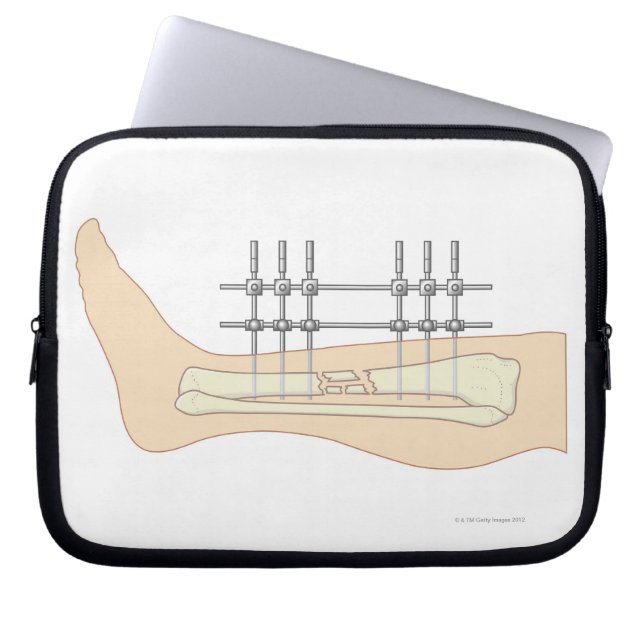 Capa Para Notebook Fixador externo (Frente)