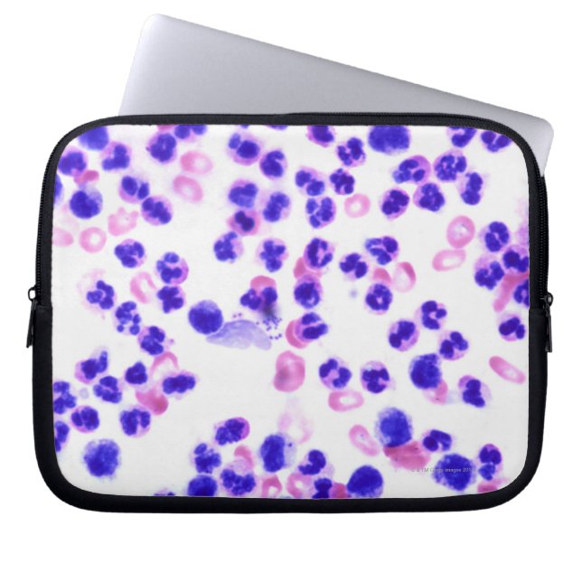 Capa Para Notebook Infecção por estafilococos (Frente)