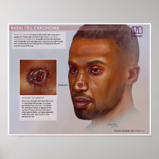 Carcinoma das Células Basais Melalógico Poster