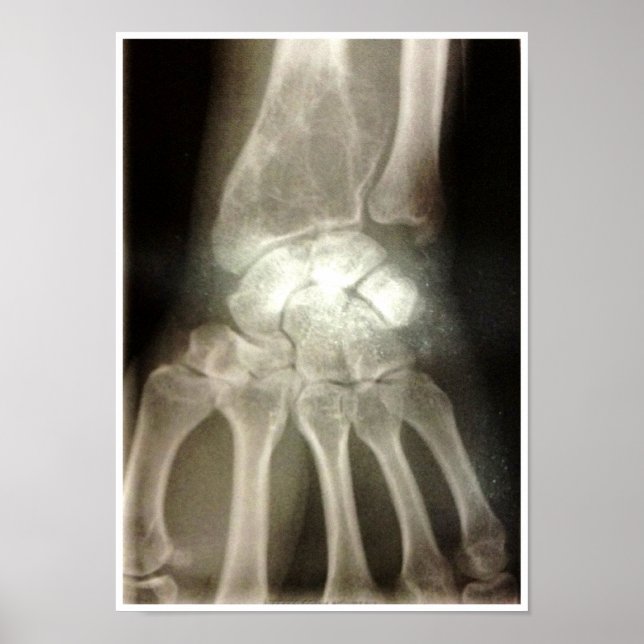 Carpals Xray Poster (Frente)