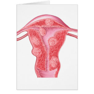 Cartão Anatomia de tumores fibroides no útero fêmea