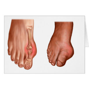 Cartão Anatomia de um pé inchado