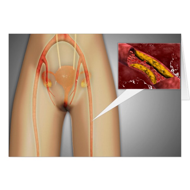 Cartão Artéria Estreita Perto do Fecho da Perna (Frente Horizontal)