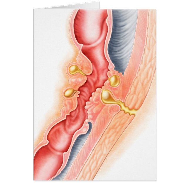 Cartão Desenvolvimento De Fístula (Frente)