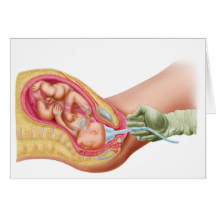 Cartão Entrega De Feto Utilizando Extração De Vácuo