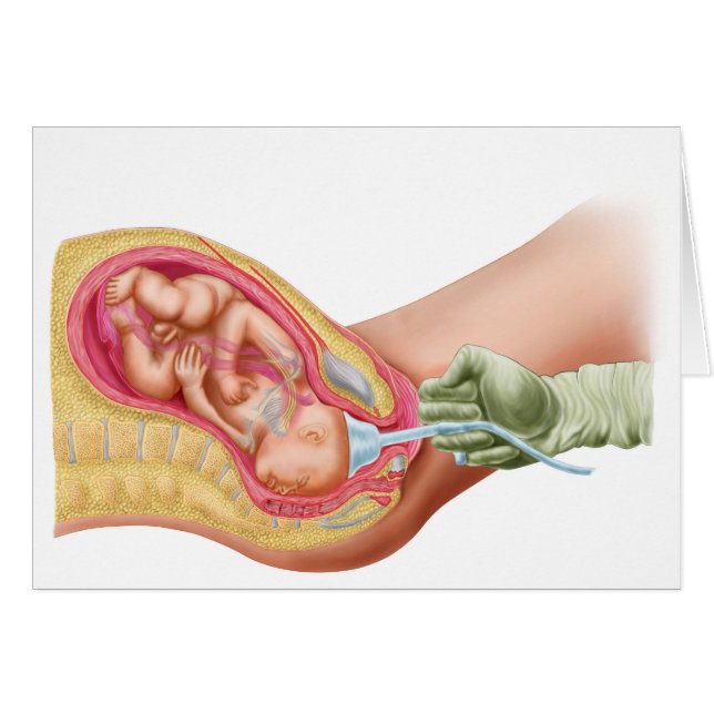 Cartão Entrega De Feto Utilizando Extração De Vácuo (Frente Horizontal)