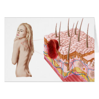 Cartão Ilustração De Crescimento Atípico Na Pele