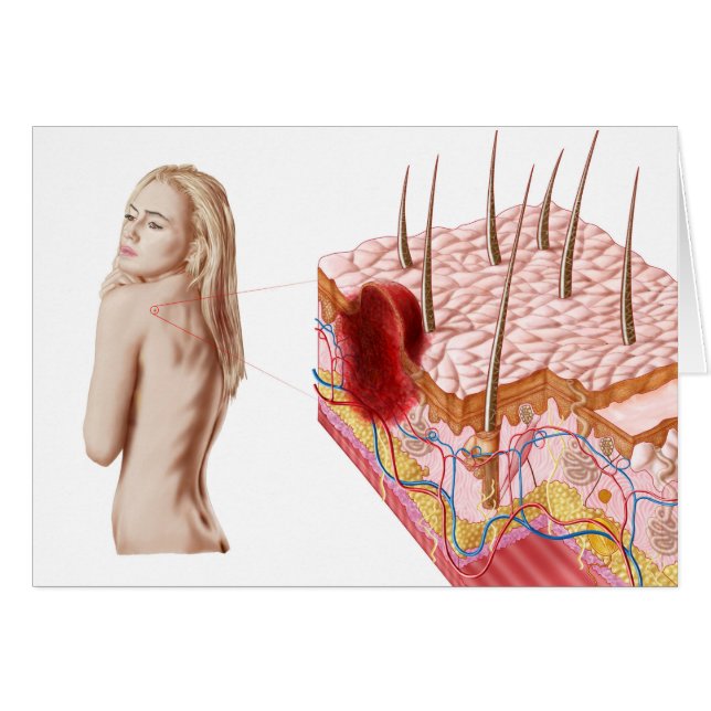Cartão Ilustração De Crescimento Atípico Na Pele (Frente Horizontal)