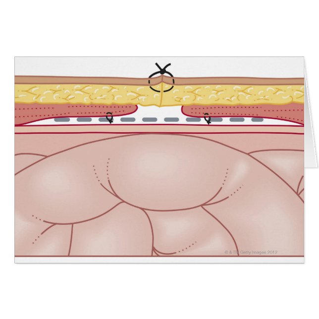 Cartão Ilustração de uma Hérnia (Frente Horizontal)
