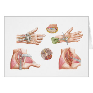 Cartão Ilustração médica que mostra o túnel do Carpal