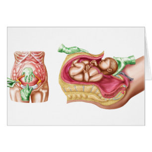 Cartão Ilustração que mostra a entrega Caesarean do fet