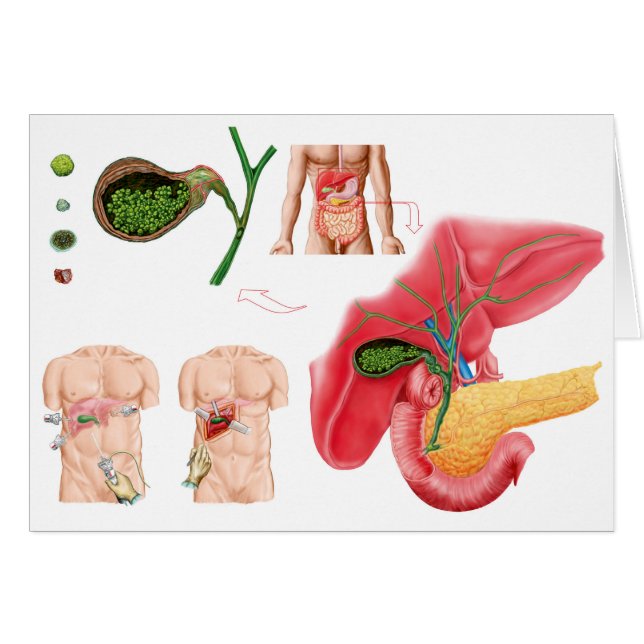 Cartão Ilustração Representando Colecistectomia (Frente Horizontal)