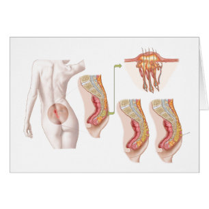 Cartão Ilustration médico de um quisto Pilonidal